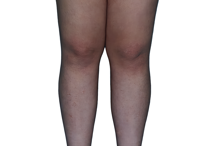 Actual 13­-year­-old female patient at Week 16 with improved atopic dermatitis on legs.