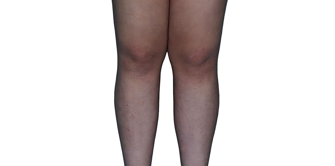 Actual 13­-year­-old female patient at Week 16 with improved atopic dermatitis on legs.