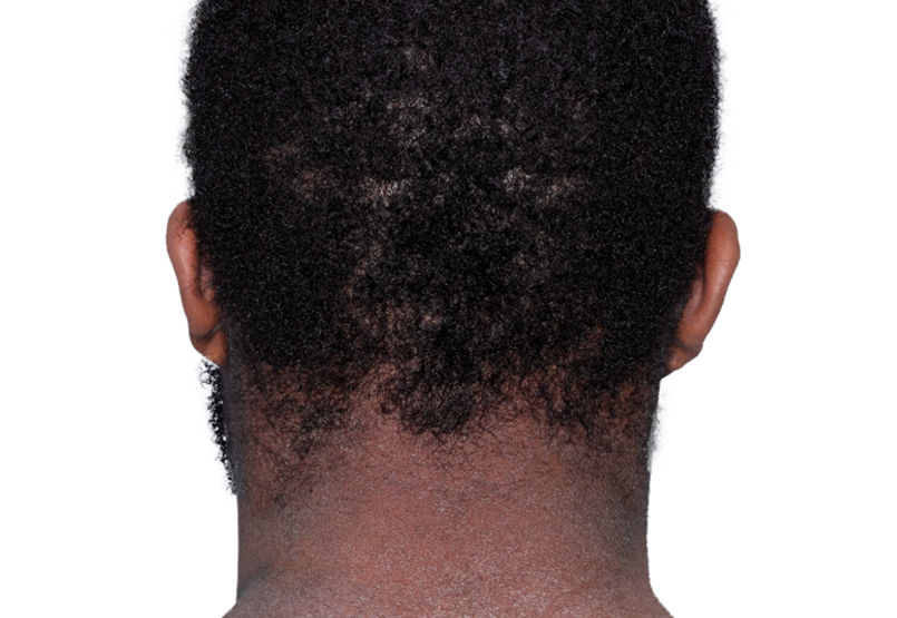 Actual 23­-year­-old male patient at baseline with atopic dermatitis on back of neck.