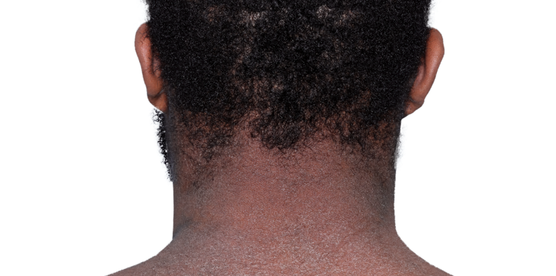 Actual 23­-year­-old male patient at baseline with atopic dermatitis on back of neck.