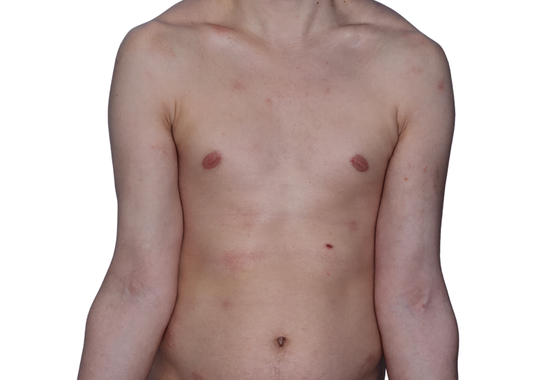 Actual 26­-year­-old male patient at Week 16 with improved atopic dermatitis on chest and arms.