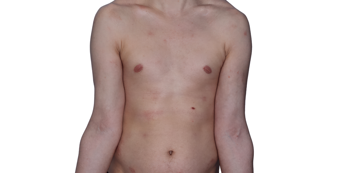 Actual 26­-year­-old male patient at Week 16 with improved atopic dermatitis on chest and arms.