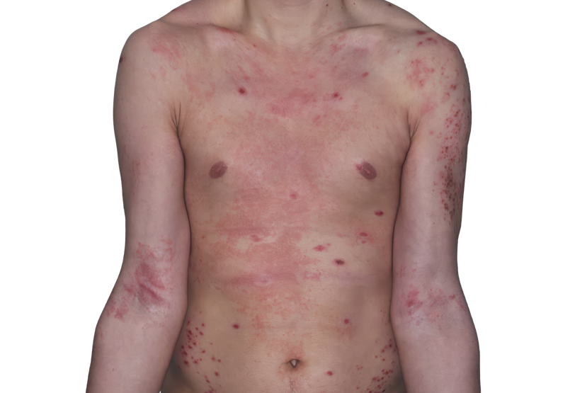 Actual 26­-year­-old male patient at baseline with atopic dermatitis on arms and chest.