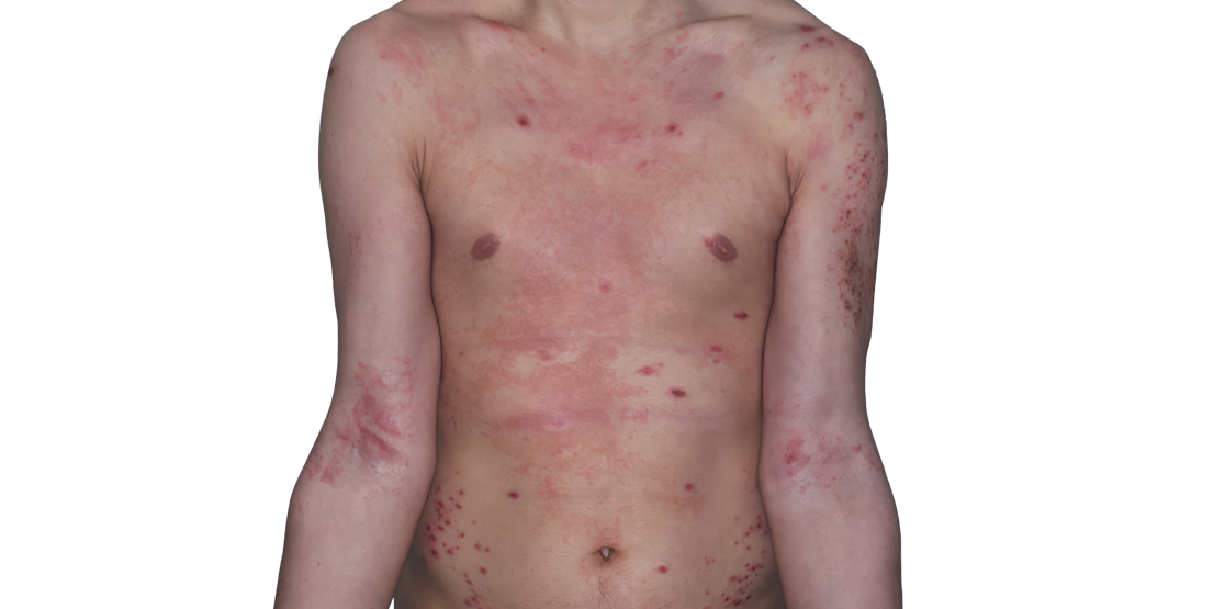 Actual 26­-year­-old male patient at baseline with atopic dermatitis on arms and chest.