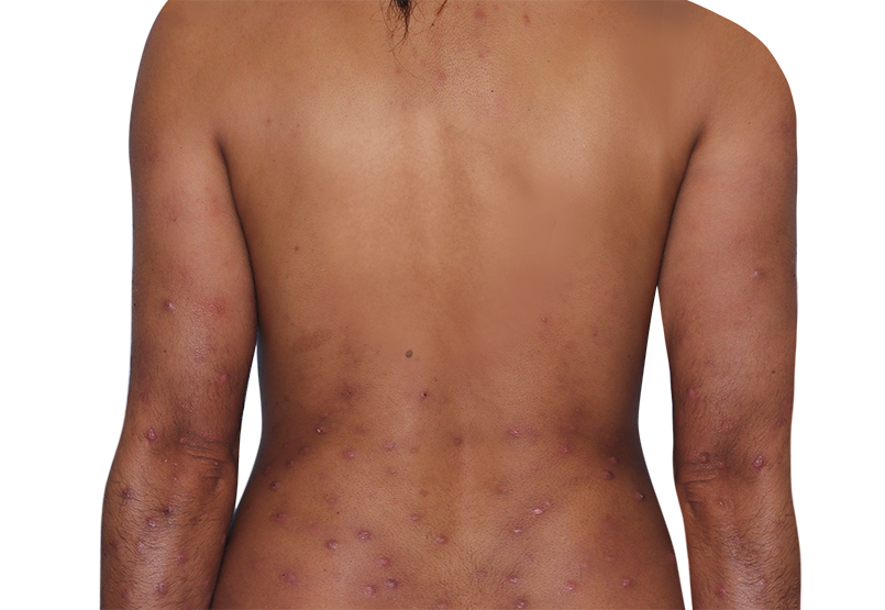 Image of an actual 31­-year­-old female patient at baseline with prurigo nodularis nodules on back and arms.