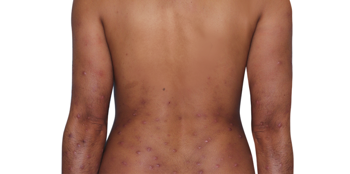 Image of an actual 31­-year­-old female patient at baseline with prurigo nodularis nodules on back and arms.