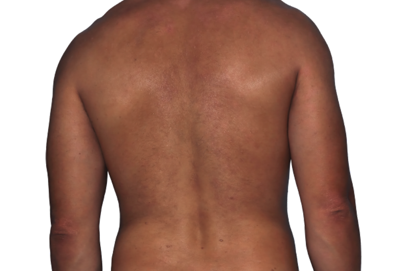 Actual 42­-year­-old male patient at Week 16 with improved atopic dermatitis on back and arms.