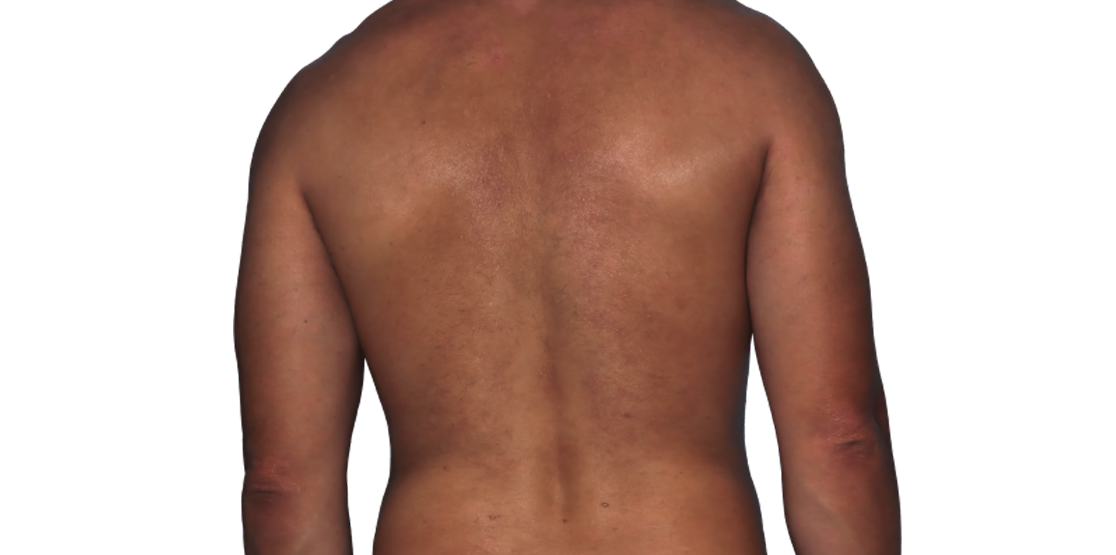 Actual 42­-year­-old male patient at Week 16 with improved atopic dermatitis on back and arms.