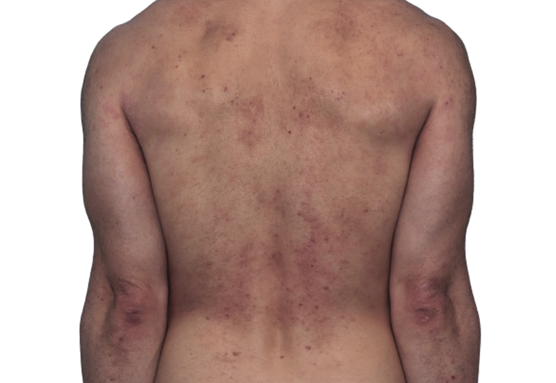 Actual 42­-year­-old male patient at baseline with atopic dermatitis on back and arms.