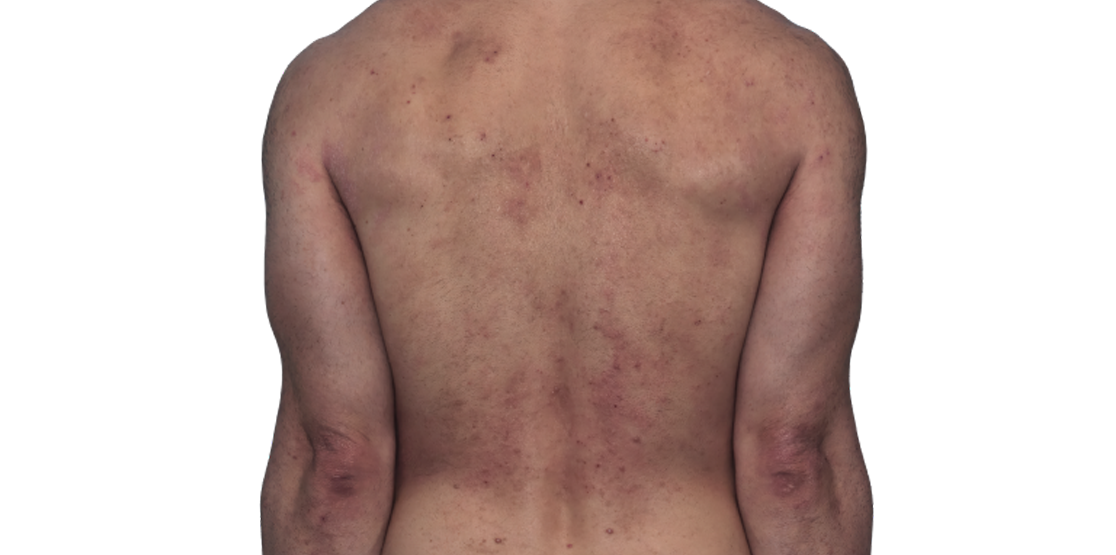 Actual 42­-year­-old male patient at baseline with atopic dermatitis on back and arms.