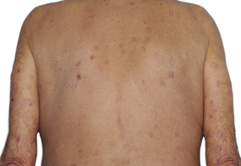 Image of an actual 73­-year­-old male patient with reduced raised bumps and nodules after NEMLUVIO® (nemolizumab­-ilto) treatment for prurigo nodularis (PN).