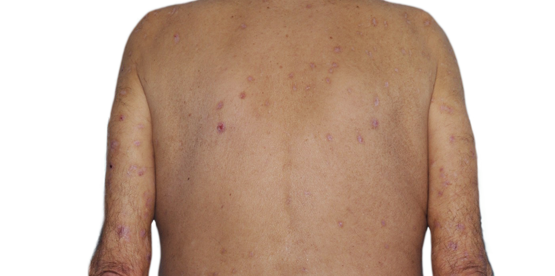 Image of an actual 73­-year­-old male patient with reduced raised bumps and nodules after NEMLUVIO® (nemolizumab­-ilto) treatment for prurigo nodularis (PN).