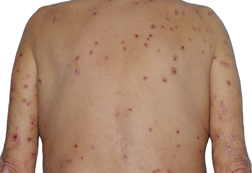 Image of an actual 73­-year­-old male patient at baseline with raised bumps and nodules before NEMLUVIO® (nemolizumab­-ilto) treatment for prurigo nodularis (PN).