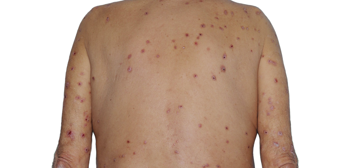 Image of an actual 73­-year­-old male patient at baseline with raised bumps and nodules before NEMLUVIO® (nemolizumab­-ilto) treatment for prurigo nodularis (PN).