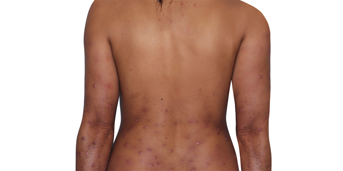 31-year-old female actual patient at baseline with prurigo nodularis nodules on back and arms